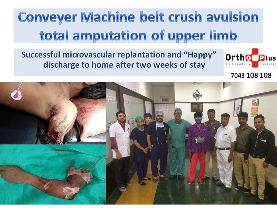 Conveyer Machine belt crush avulsion total amputation of
