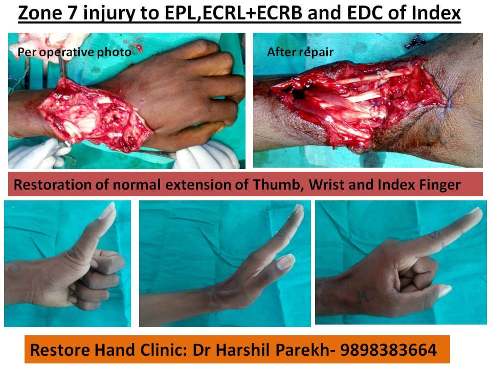 Extensor tendon injury