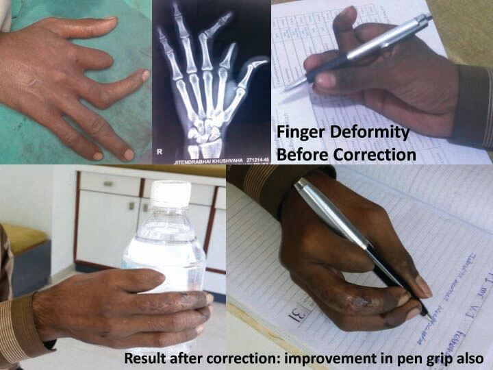 Finger deformity correction