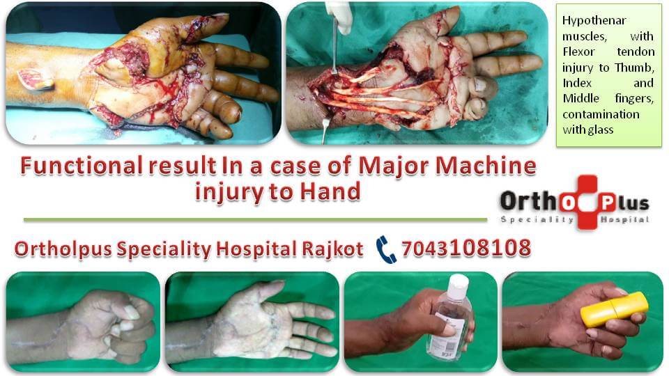 Flexor tendon injury