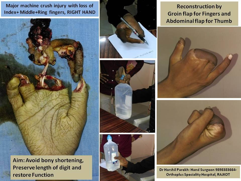 Groin flap to fingers