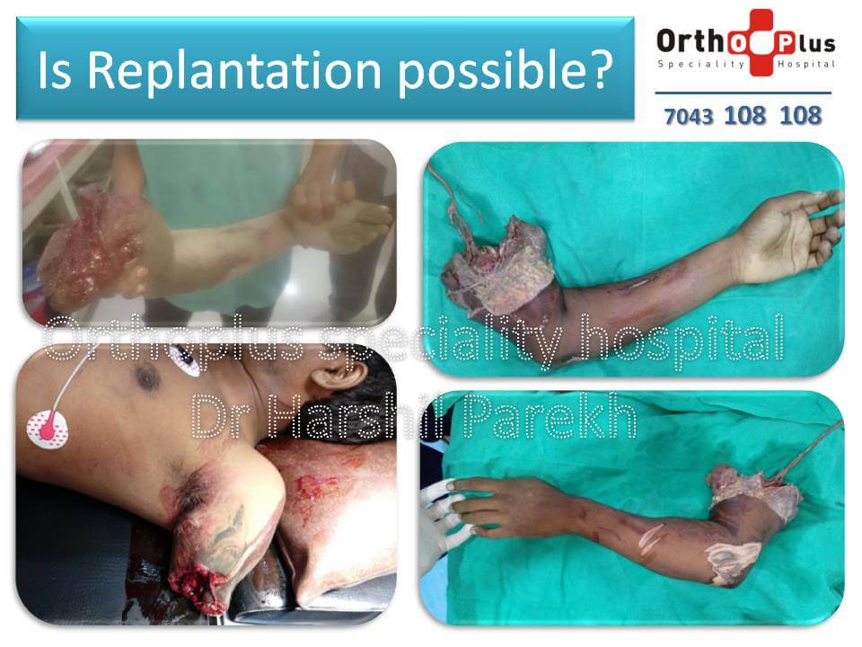 Is Replantation possible