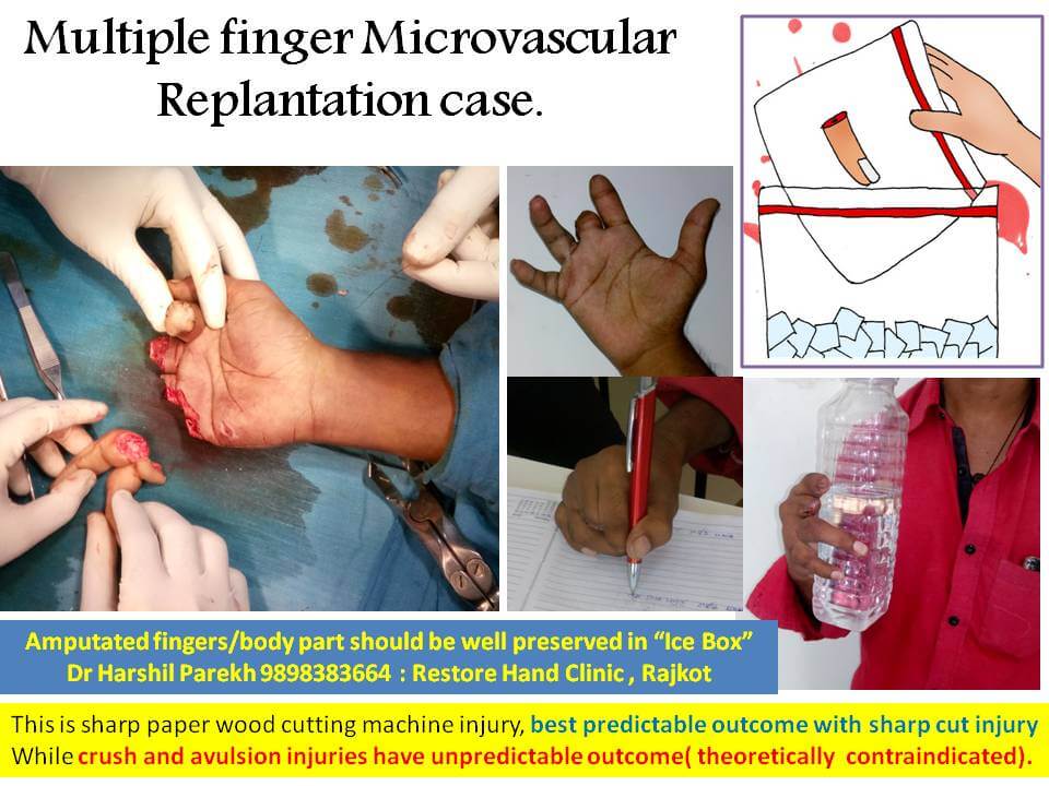 Microvascular finger replantation