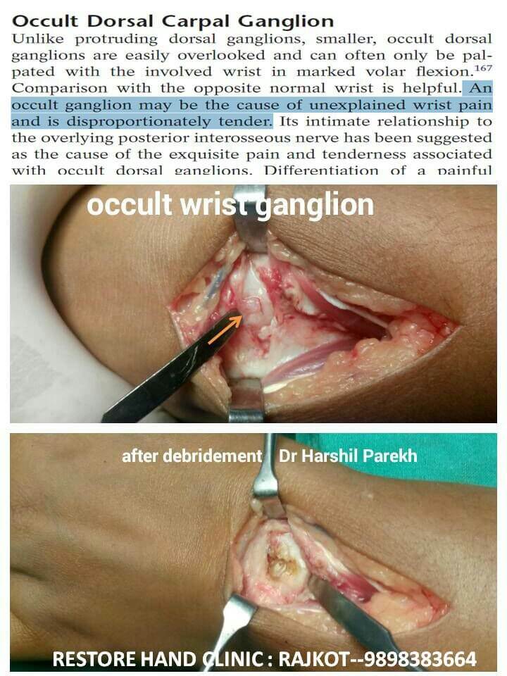 Occult wrist ganglion