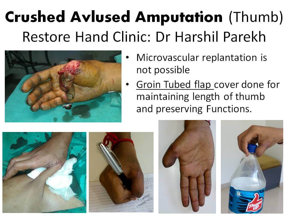 Thumb Tubed groin flap