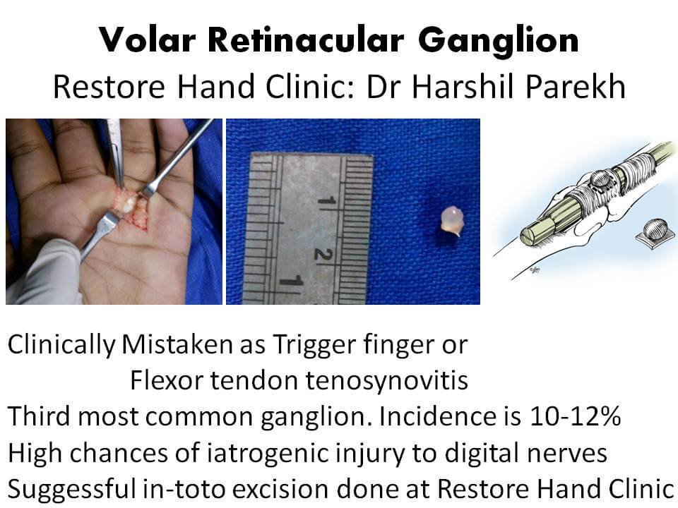 Volar Retinacular Ganglion