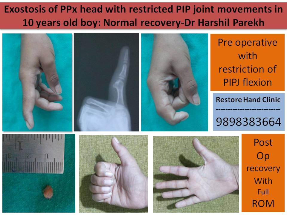 Finger tumour PIP jointtiffness