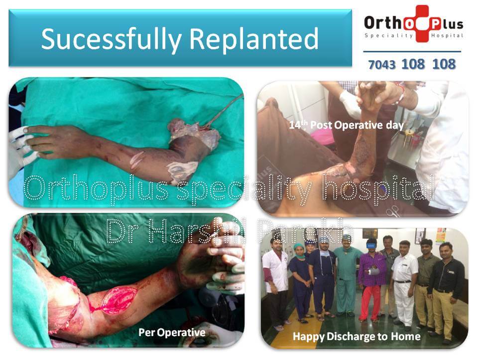 Is Replantation possible