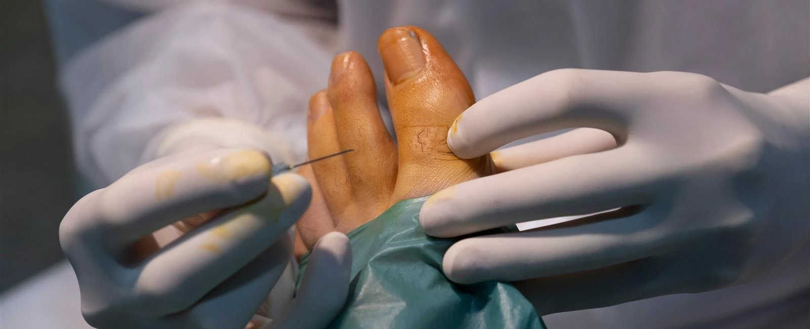 Foot and Ankle Surgery