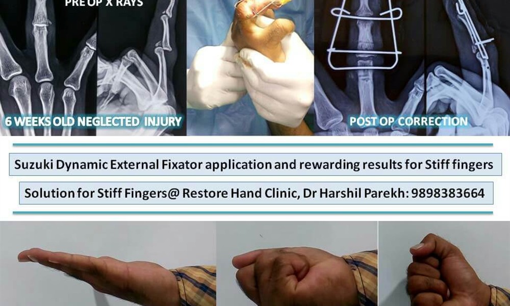 Hand Injury